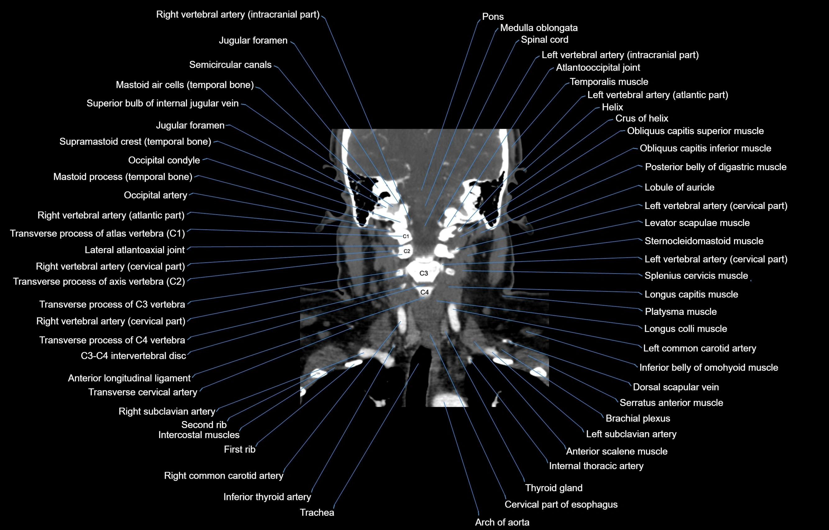 CT Neck coronal  cross sectional anatomy labelled 3D  radiology  image-00041.webp